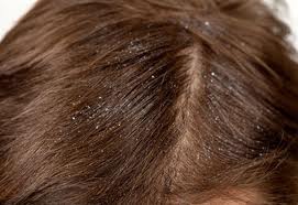 ما علاج القشرة علي الشعر
