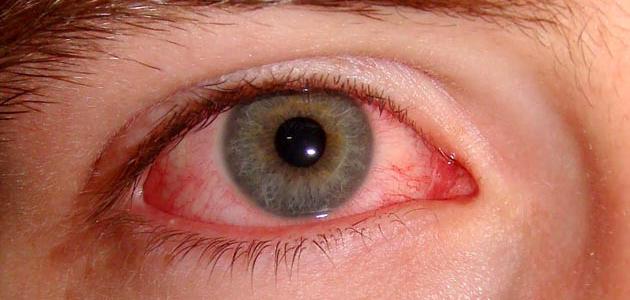 أمراض العين وكيفية الوقاية منها