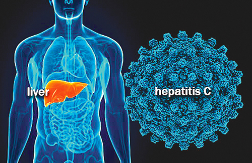 علاج الالتهاب الكبدي الوبائي فيروس سي واعراضه Hepatitis C