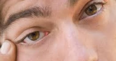 أعراض وأسباب غير شائعة لالتهابات جفن العين   حصري على لحظات