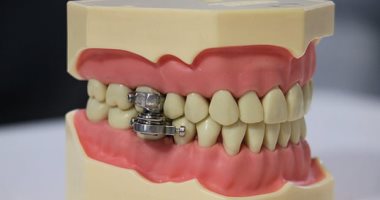 3 أسباب لفقدان الأسنان وتساقطها غير شائعة.. تعرف عليها   حصري على لحظات
